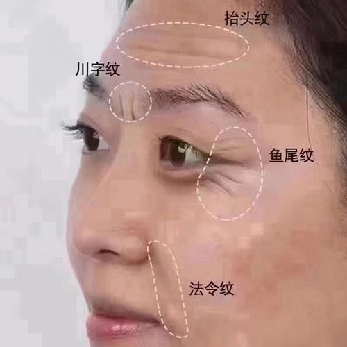 鱼尾纹形状各异，交叉分布的鱼尾纹对男人面相有何影响？(图3)